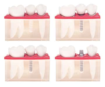 Dental implant diagram.